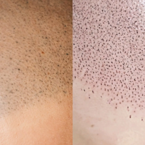 4D-Technik im direkten Vergleich zu einer anderen Haarpigmentierung in Berlin 4D-Technik im direkten Vergleich zu einer anderen Haarpigmentierung in Berlin