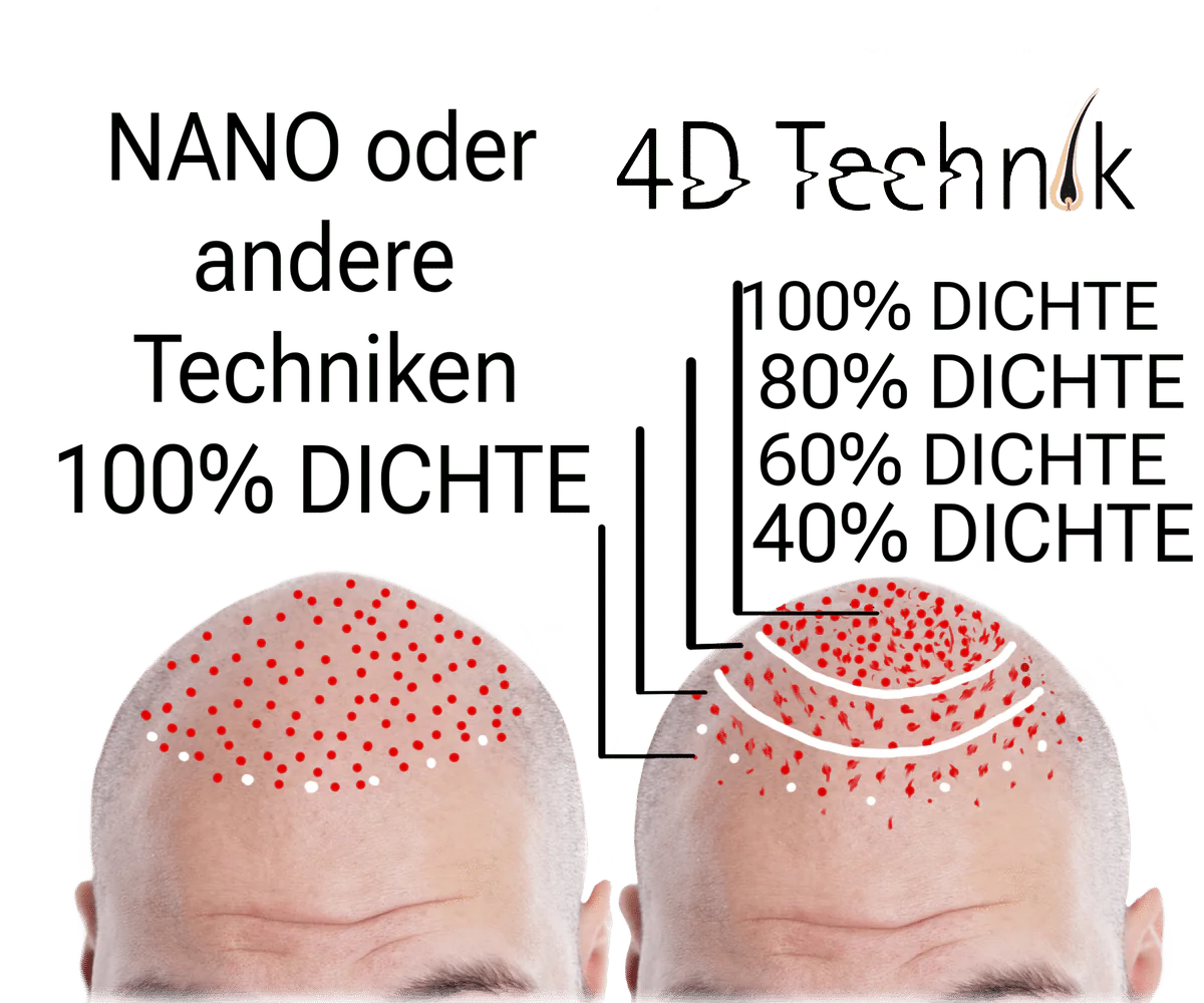 Nano oder andere Techniken zur Haarpigmentierung - Vergleich der Haardichte Nano oder andere Techniken zur Haarpigmentierung - Vergleich der Haardichte